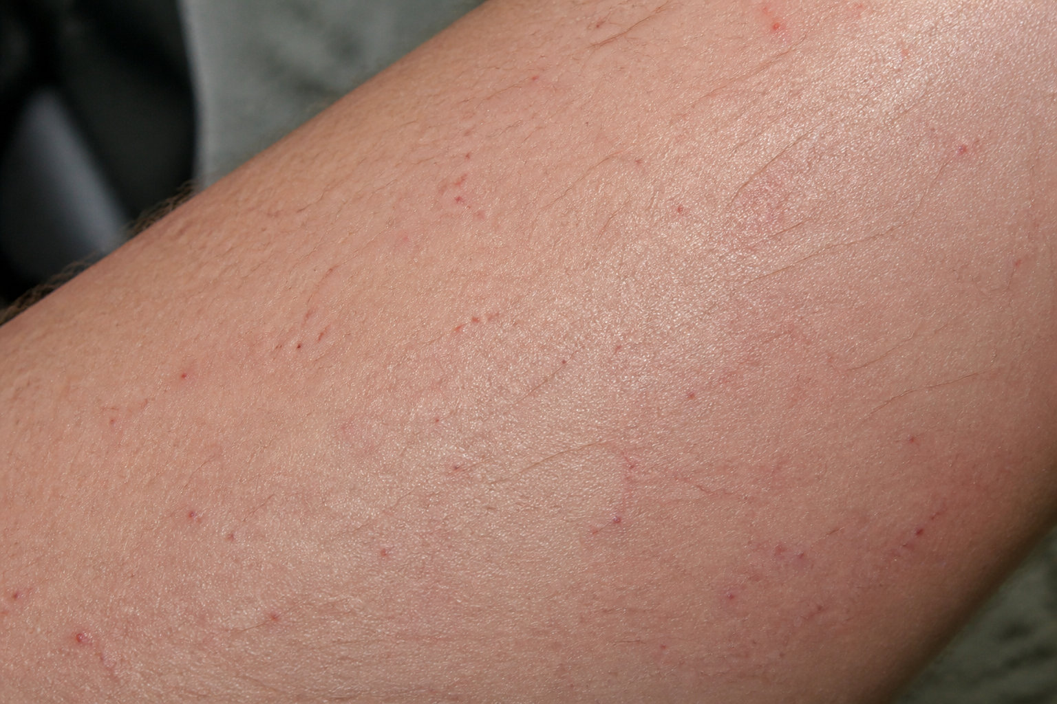 Pétéchies ou inflammation : comment faire le tri ?